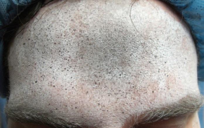Forehead Prep
