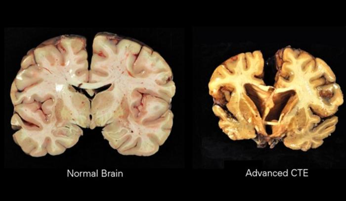 Chronic traumatic encephalopathy is a serious health concern for contact sport athletes resulting in cognitive defect