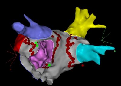 3-D Map of the Left Atrium