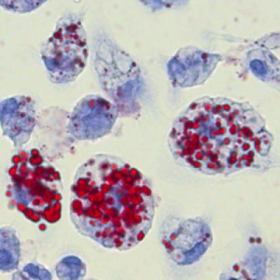 Foamy Macrophages