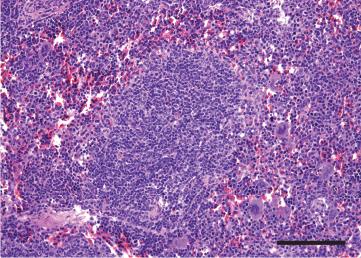 Sensitizing Stubborn Lymphoma Cells to Treatment