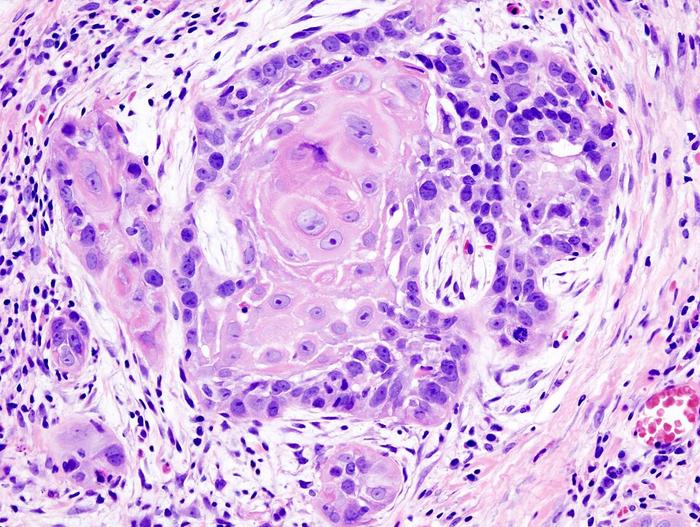 Rethinking Drug Delivery for Oral Cancer