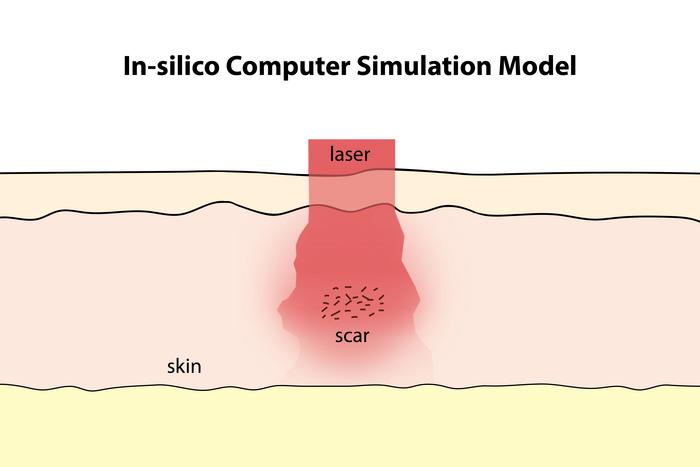 Laser treatment for scars and discoloration