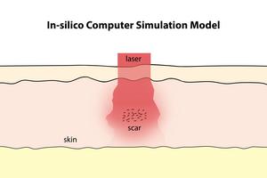 Laser treatment for scars and discoloration