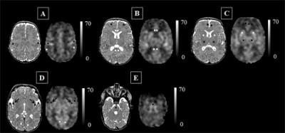 Figure 1: Cerebral Blood Flow Maps