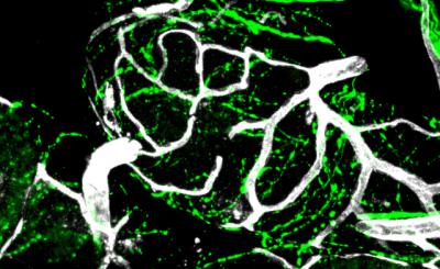 Innervation and Vasculature Neoplasm