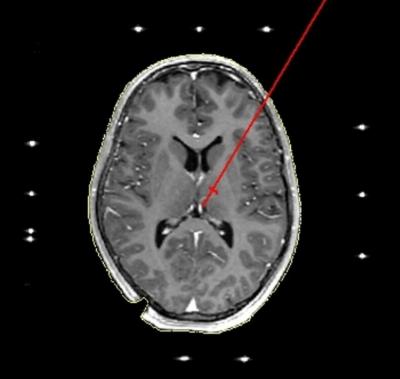 Pathway of an Electrode in the Brain