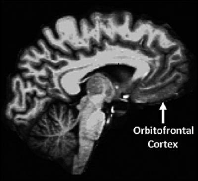 Personality/Brain Aging, Orbitofrontal Cortex