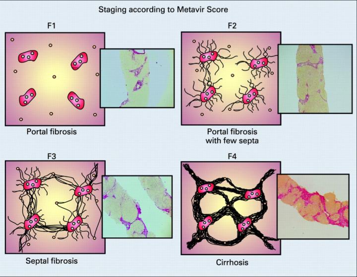 Stages of Fibrosis