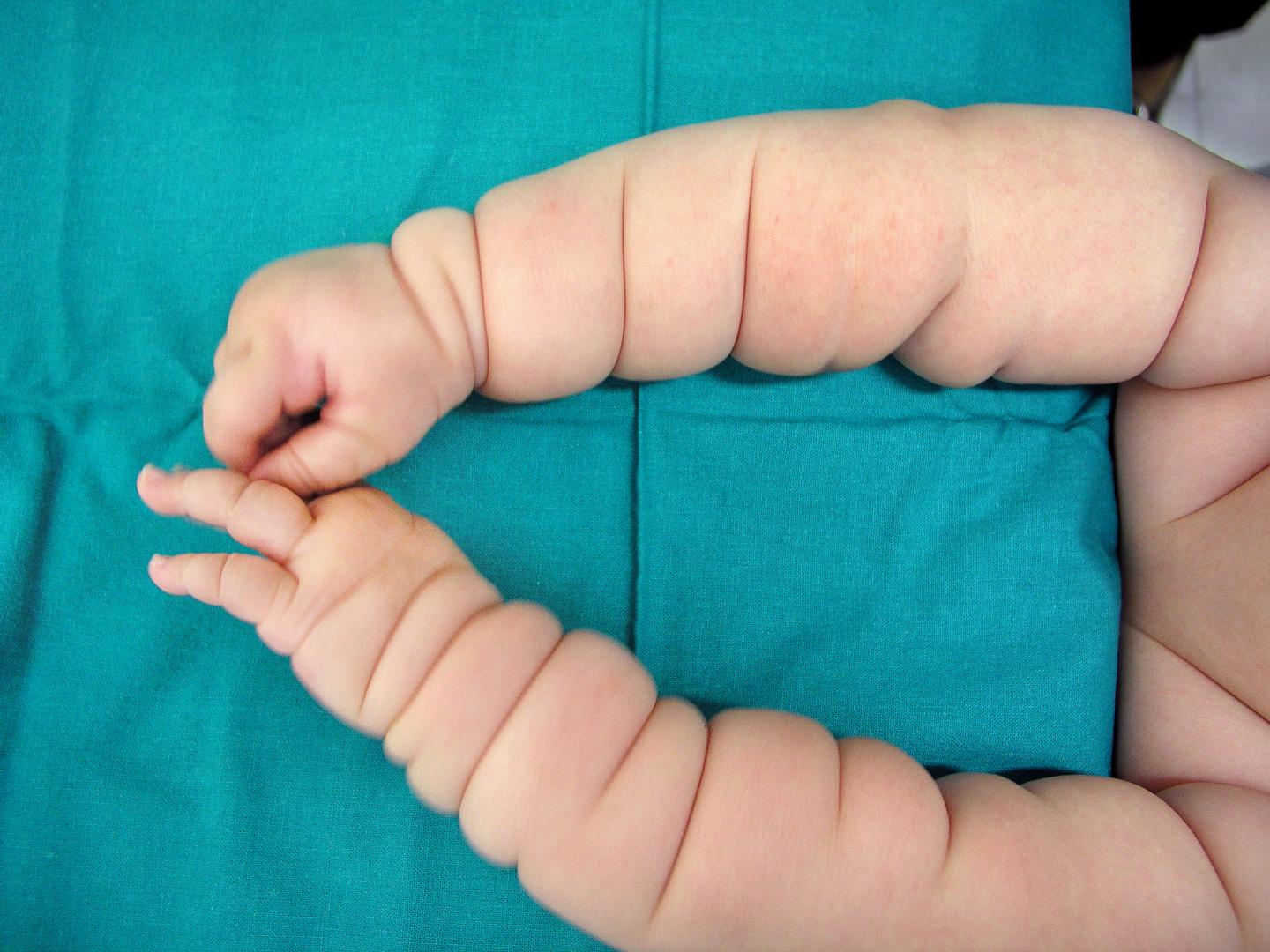 Two Genes Linked To Intellectual Disability And Circular Skin Creases On Limbs