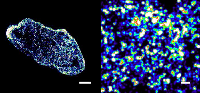 STORM imaging of bowel cancer cells