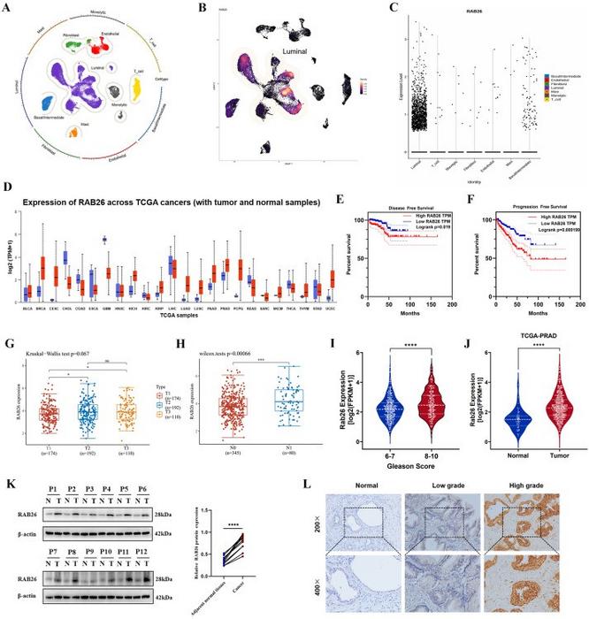 Analysis of clinical correlation between RAB26 expression in prostate cancer