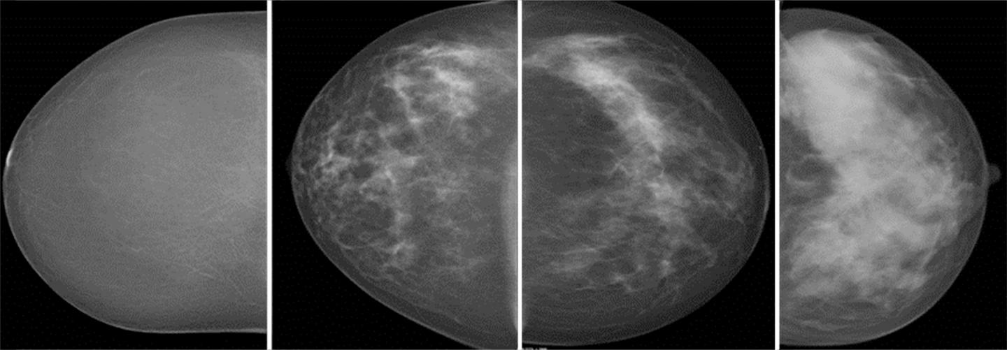 Mammograms Showing Volumetric Breast Density