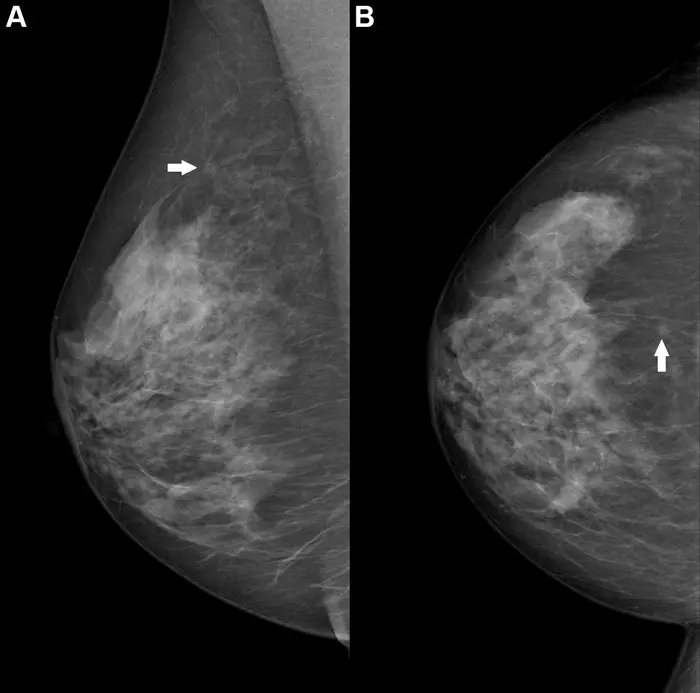 Right breast mammogram in a 69-year-old woman