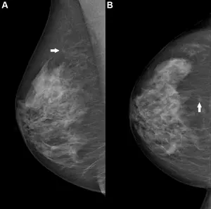 Right breast mammogram in a 69-year-old woman