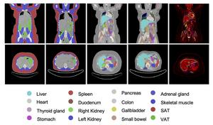 Representative whole-body PET/CT based organ and tissue segmentation before and 12 months after bariatric surgery in a 20-year-old woman.