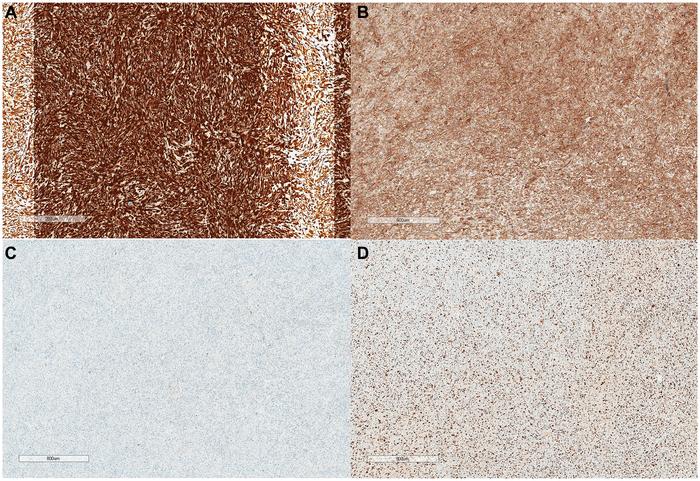 Laryngeal leiomyosarcoma: A rare case report and literature review