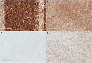 Laryngeal leiomyosarcoma: A rare case report and literature review