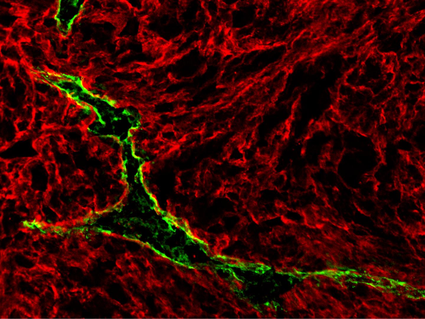 Intratumoral Lymphatic Vessel in the Microenvironment of a Melanoma Tumor