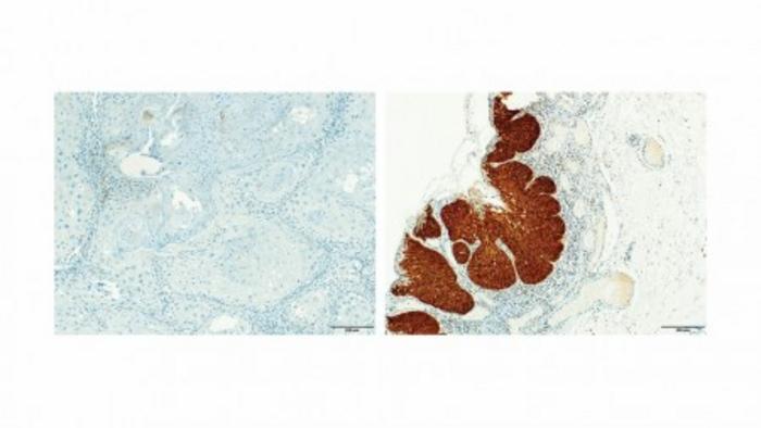 Study finds that common bacteria in the mouth can help predict the progression of head and neck cancer