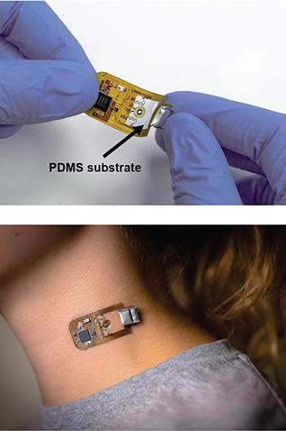 Wireless Skin Sensors Detect Shunt Malfunction in Patients with Brain Fluid Buildup (2 of 3)