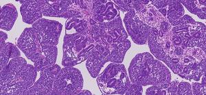 Wilms Tumour with FOXR2 genetic change