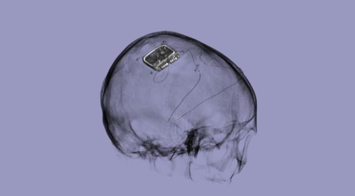 Picostim neurostimulator