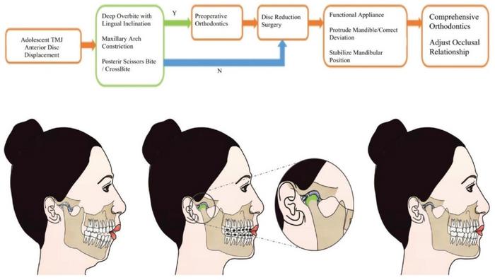 This illustration was drafted by Prof. Yang himself and finished by his students. It depicts the sequential strategy for combined joint–mandible–occlusion diagnosis and treatment. Before and after the disc reduction surgery, preoperative orthodontics,