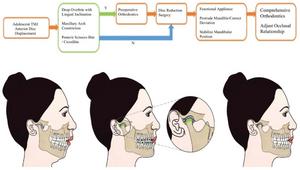 This illustration was drafted by Prof. Yang himself and finished by his students. It depicts the sequential strategy for combined joint–mandible–occlusion diagnosis and treatment. Before and after the disc reduction surgery, preoperative orthodontics,