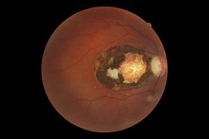 Toxoplasmose macular