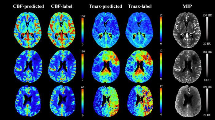 Fig. 1. CBF and Tmax maps derived from the model and CTP showing three patients with different cores and low perfusion volumes in the test dataset and the corresponding maximum intensity projection (MIP) maps from the three-phase CTP.