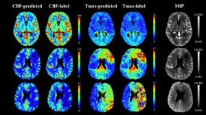 Fig. 1. CBF and Tmax maps derived from the model and CTP showing three patients with different cores and low perfusion volumes in the test dataset and the corresponding maximum intensity projection (MIP) maps from the three-phase CTP.