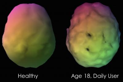 New Study Shows Marijuana Users have Low Blood Flow to the Brain