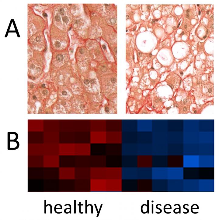 Non Alcoholic Fatty Liver Disease, Figure 1