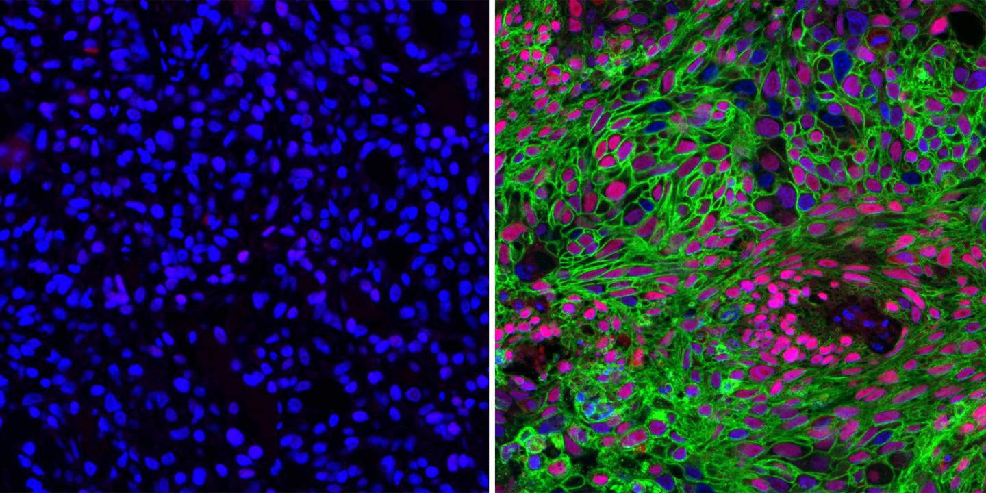 Study Sweetens Connection Between Cancer and Sugar