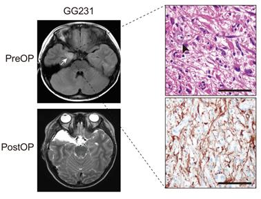 Figure Preoperative and Postoperative Brain MRI