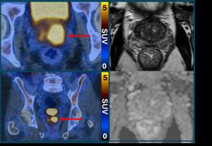 PRIMARY2 PSMA PET/CT vs MRI