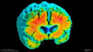 Amyloid PET scan