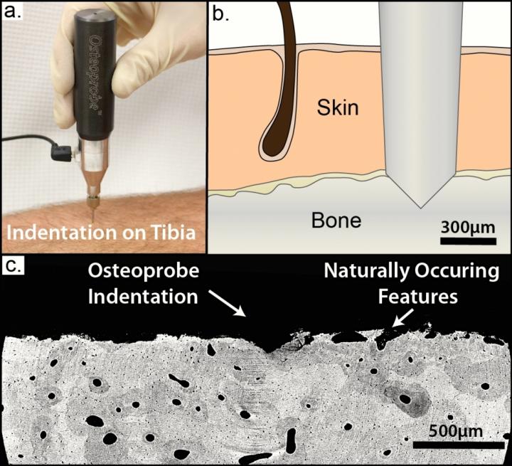 Osteoprobe