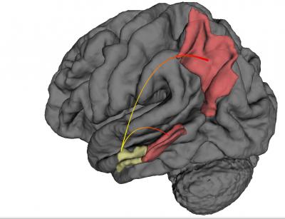 Study Shows Where Alzheimer's Starts and How it Spreads
