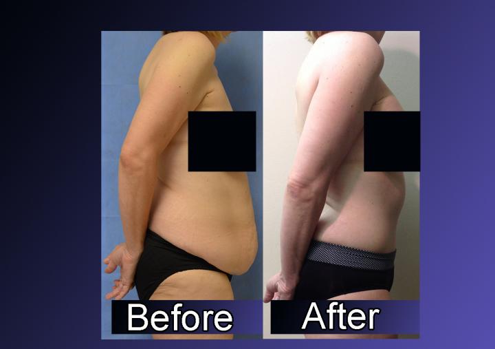 Numbers Show Increase in Sculpting Procedures after Massive Weight Loss