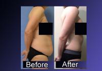 Numbers Show Increase in Sculpting Procedures after Massive Weight Loss