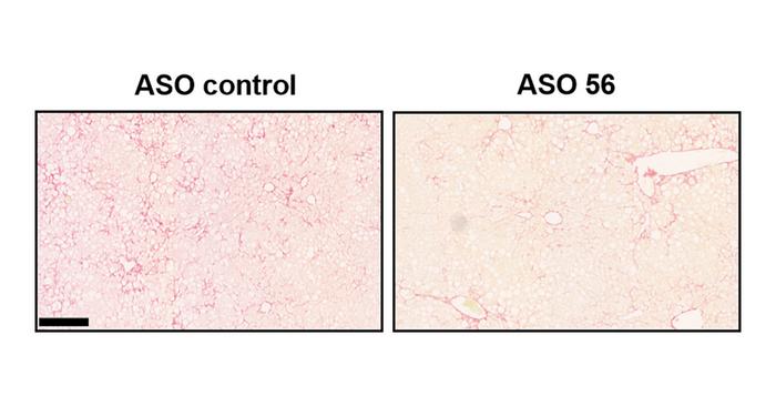 liver fibrosis