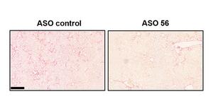 liver fibrosis