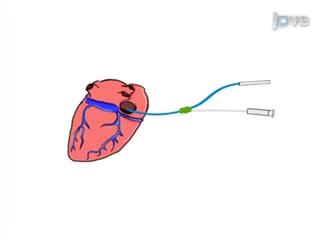 Video Article on Reconstructing the Human Heart Using CT