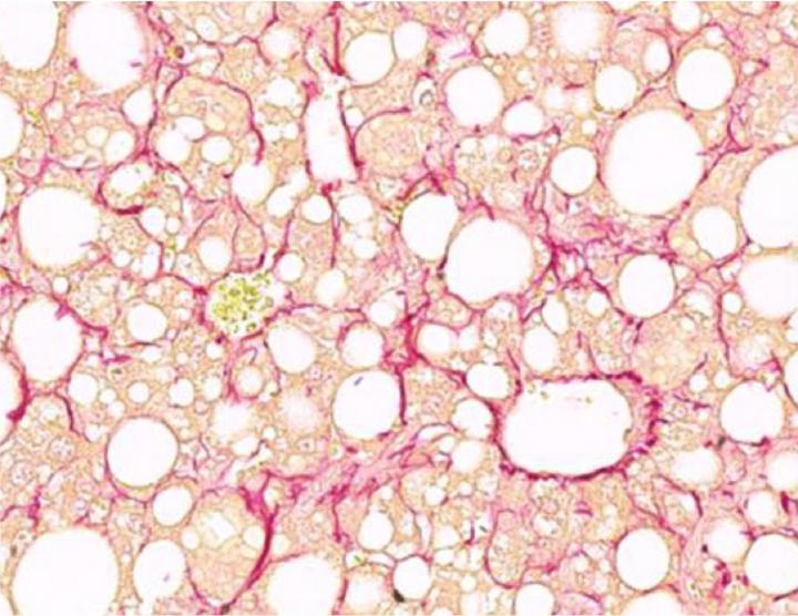 Fibrotic liver section