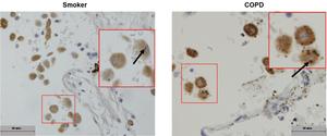Lung cells containing soot-like particles