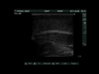 Stem Cells Show Promise for Treating Infertility in Cancer Patients (2 of 2)