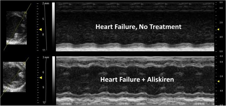 Aliskiren Study