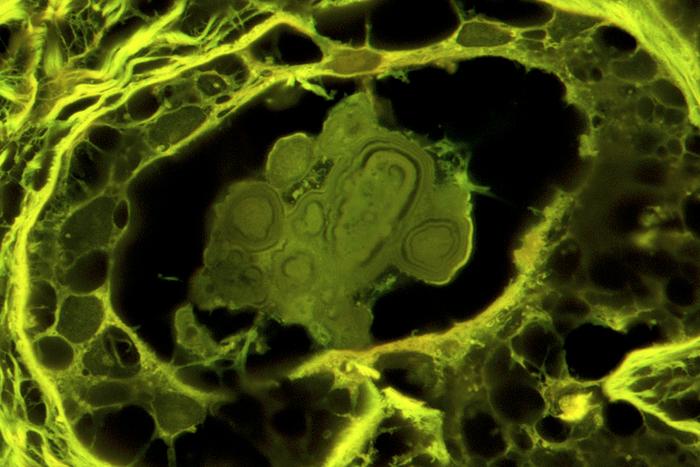 Benign breast disease nodules